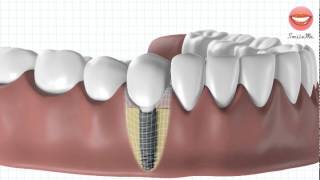 Vidéo de démonstration pour une pose dimplant dentaire [upl. by Namurt]