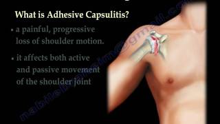 Adhesive Capsulitis frozen shoulder  Everything You Need To Know  Dr Nabil Ebraheim [upl. by Aggappora]