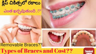 Types of Braces in Telugu Howmuch does Braces Cost in IndiaWhat are Removable Braces or Aligners [upl. by Robb135]