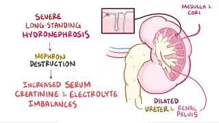 Hydronephrosis  Renal Pathology  Osmosis [upl. by Lamiv157]