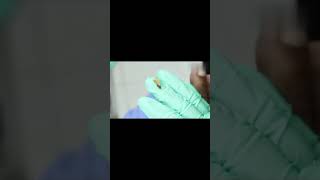 Ingrown toenail removal with Pedicure Knife Cut it easily Ep443 [upl. by Yespmed]