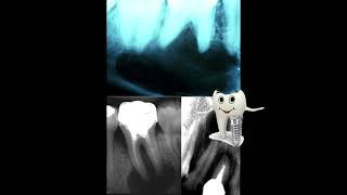 Oral Cysts [upl. by Nevyar]