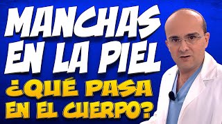 MANCHAS EN LA PIEL  ¿Qué pasa dentro del cuerpo de las personas que las padecen [upl. by Adnohsed]