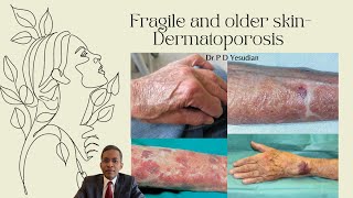 Fragile and thin skin  Dermatoporosis [upl. by Jeffrey]