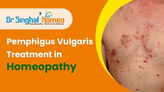 Best Homeopathic Treatment for Pemphigus Vulgaris  Dr Singhal Homeo [upl. by Alesandrini]