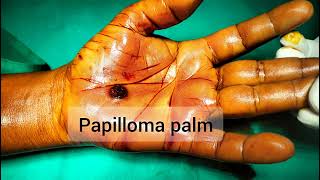 Viral Papilloma of palm Excision under anaesthesia [upl. by Spancake]