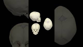 Congenital skull abnormalities craniosynostosis skull skulldeformity flathead fauquierent [upl. by Nostets]