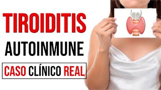 Tiroiditis autoinmune DIAGNÓSTICO Y TRATAMIENTO Caso clínico Mar Alonso [upl. by Debby]