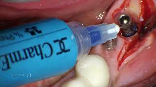 Periimplantitis treatment with InterOss colagen [upl. by Yenruoj]