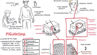 Melanoma  Overview signs and symptoms pathology risk factors treatment [upl. by Enorahs541]