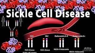 Sickle Cell Disease Animation [upl. by Sky]