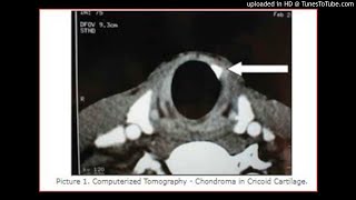 Chondroma of The Cricoid CartilageThe larynx cartilaginous tumors [upl. by Scully]