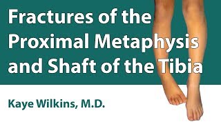 Fractures Of The Proximal Metaphysis amp Shaft Of The Tibia [upl. by Lewin]