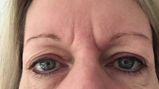 Hooded Eye Lids  Plasma Pro  Plasma Blast  Fibroblast [upl. by Vernita]