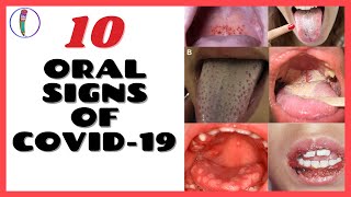 ORAL SIGNS OF CORONAVIRUS COVID 19  CORONAVIRUS SYMPTOMS [upl. by Huan686]