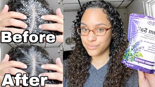 EPSOM SALT SCALP SCRUB Before  After [upl. by Hermy]