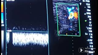 Ultrasound of Anatomy of Saphenofemoral Junction [upl. by Atokad196]