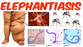 Lymphatic Filariasis  Elephantiasis [upl. by Terpstra]