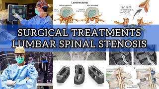 Surgical Treatment For Lumbar Spinal Stenosis Part 2 [upl. by Ynned]