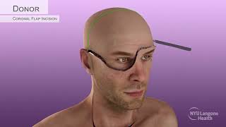 Aaron Jamess PartialFace amp TotalEye Transplant Surgical Animation 2023 [upl. by Atnima]