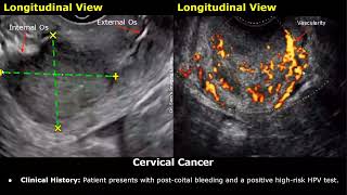 Cervix Ultrasound Reporting  Nabothian Cysts Polyp Fibroid Cervical Incompetence Cancer USG [upl. by Leonard749]