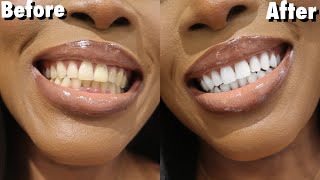 😮 Top 2 Natural Ingredients To Whiten Teeth At Home WITHOUT Hydrogen Peroxide Alkaline [upl. by Dobrinsky]