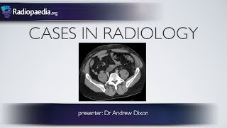 Cases in Radiology Episode 5 trauma CT abdomen [upl. by Tatianna]