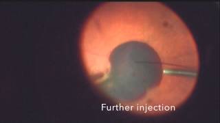 Submacular Tpa for large sub macular bleed in wet AMD [upl. by Ahsenat]