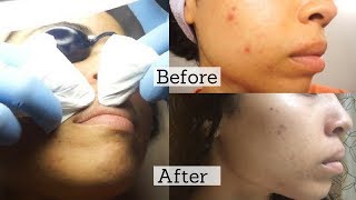 Facial Extractions What You Need to Know  Before amp After Results [upl. by Lahcym]