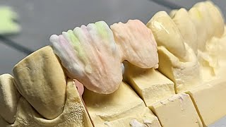 ASMR IPS Emax Ceram Layered  2units  Dental Aesthetic [upl. by Ahsenet]