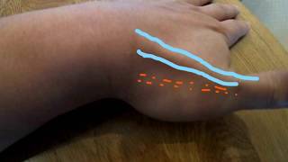 Howto Ultrasonography  De Quervain disease [upl. by Shani]