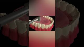 Tooth Cavity Filling Procedure tooth health shorts [upl. by Ashil757]