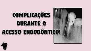 Possíveis Complicações no Acesso Endodôntico  Artigo Científico Para Dentistas DE 11 [upl. by Ebner]