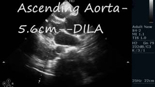 DISSECTION OF AORTA  ECHOCARDIOGRAPHY SERIES BY DR ANKUR K CHAUDHARI [upl. by Semela907]