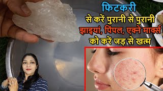 fitkari ke faydeसिर्फ 3 दिन Use कर लो Acne Pimple Tiny Bumps खत्म  How To Use fitkari on face [upl. by Horner]