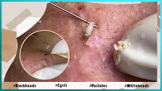 Big Cystic Acne Blackheads Extraction Blackheads amp Milia Whiteheads Removal Pimple Popping [upl. by Stets]