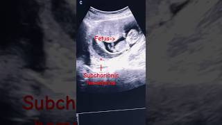 Subchorionic Hematomasubchorionic hemorrhage  1st trimester ultrasound ytshorts baby pregnancy [upl. by Laws]