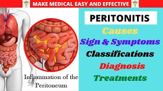 PERITONITIS Anatomy Causes Sign and Symptoms ClassificationsComplications DiagnosisTreatments [upl. by Pfeifer]