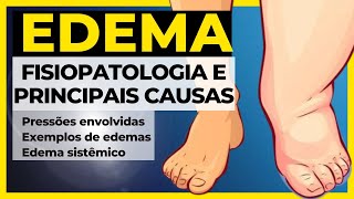 Quais as Causas de um Edema Resumo Patologia geral  Edema Fisiopatologia Atualizado [upl. by Carrol]