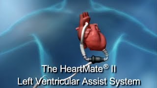 The HeartMate II Left Ventricular Assist System [upl. by Aicelav345]