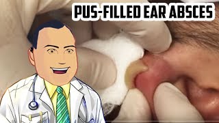 PusFilled Ear Abscess Drained  Revisited Popping [upl. by Asilem]