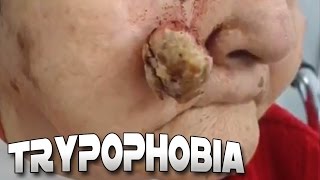 Cysts Blackheads Skin amp Trypophobia [upl. by Sivad]