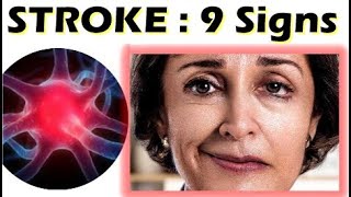 9 Warning Signs of a Stroke  Spot a Stroke FAST Face Arms Speech Time [upl. by Blaire]