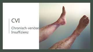 Chronisch Venöse Insuffizienz CVI was ist das und wie erkennst du sie [upl. by Vharat902]