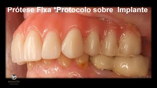 PrÃ³tese Fixa Protocolo sobre Implante Tem que trocar [upl. by Lisbeth176]