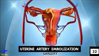 Uterine Artery Embolization  Tumor Cell Removing Surgery [upl. by Alonzo257]