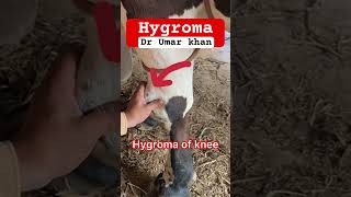 Hygroma of knee l dr Umar khan [upl. by Heyward]