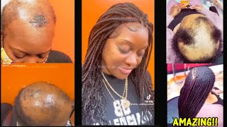 THE BEST ALOPECIA BRAID STYLES YOU EVER SEEN ON YOUTUBE [upl. by Utham]