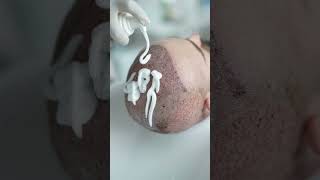 A hair transplant requires proper postsurgery care including a washing process using shampoo foam [upl. by Chanda]