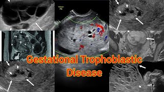 Radiology Viva Case  01  Gestational Trophoblastic disease  Molar pregnancy medical radiology [upl. by Talyah545]